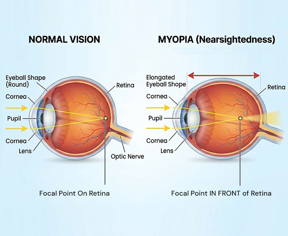 Myopia-eyeball-elongated-illustration