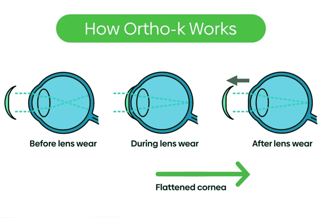Ortho-K-myopia treatment diagram