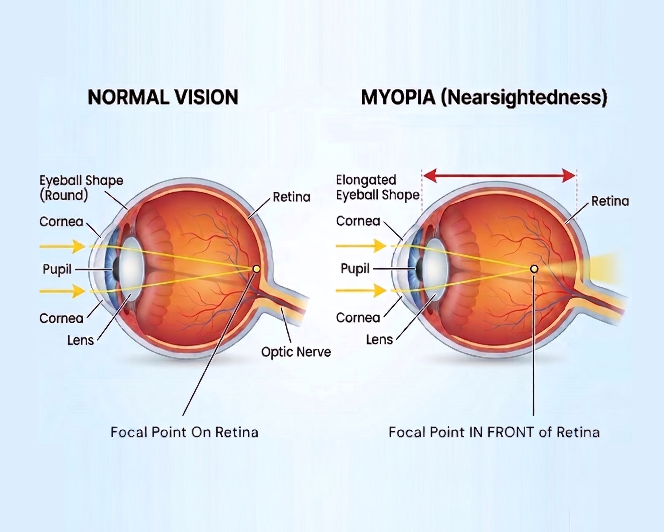 new-retina-diagram-myopia-vs-normal-eye